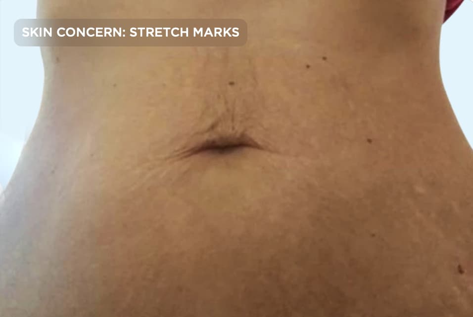 A close-up of the abdomen after stretch mark treatment, showing smoother skin with less noticeable stretch marks and improved skin texture. The image represents the results of professional skin rejuvenation treatments designed to reduce the appearance of stretch marks and improve overall skin quality.
