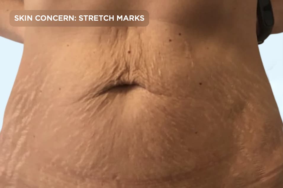 A close-up of the abdomen showing visible stretch marks and loose skin before treatment. The image represents common concerns following pregnancy or weight changes that can be improved with professional skin rejuvenation and stretch mark treatments.