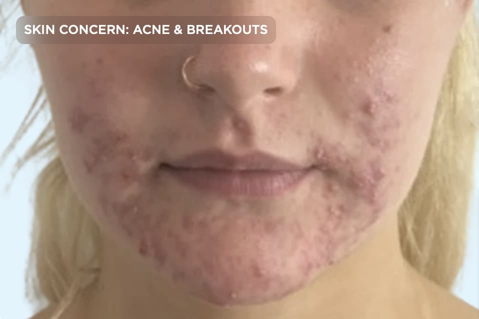 A close-up of a person's face showing moderate acne, active breakouts, and post-inflammatory blemishes on the cheeks and chin. The image represents acne concerns, acne treatment, medical-grade skincare, and professional aesthetic services to improve skin clarity and texture.