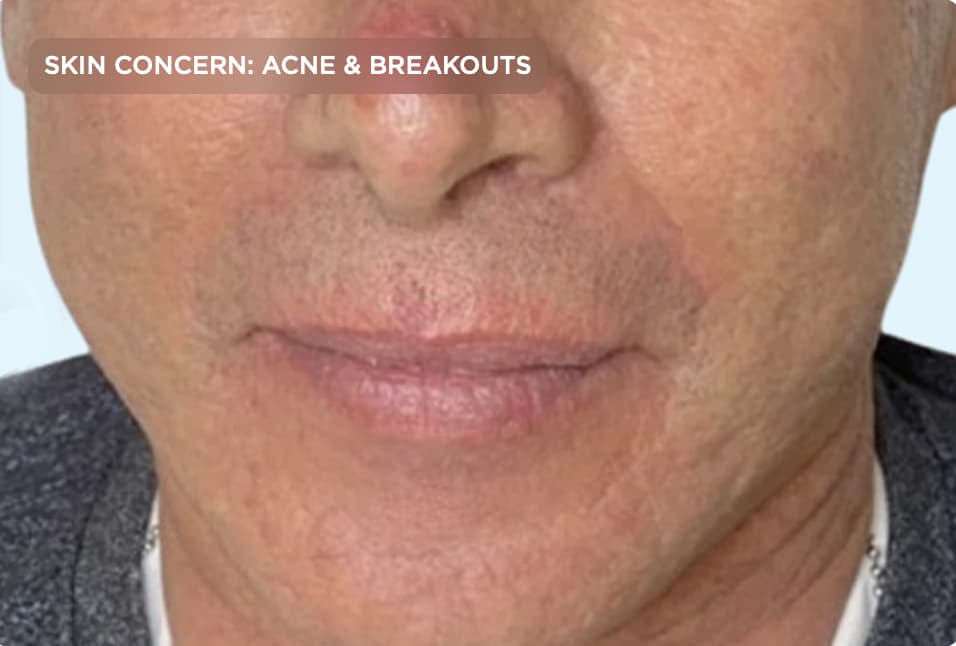 A close-up of the lower face after professional acne treatment, showing clearer skin with fewer blemishes, reduced post-acne marks, and a more even skin tone. The image represents the results of acne and skin rejuvenation treatments for adult breakouts.