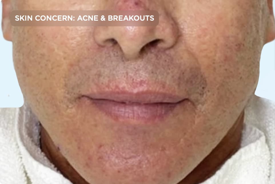 A close-up of the lower face showing active acne, post-acne marks, and uneven skin texture around the cheeks, chin, and mouth before treatment. The image represents adult acne and breakouts that can be improved with professional acne and skin rejuvenation treatments.