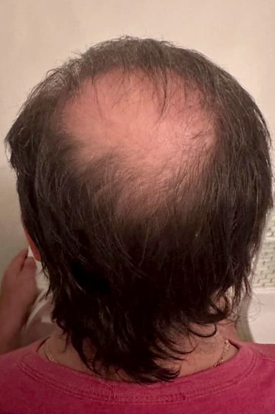A rear view of a person's scalp showing extensive hair loss across the crown and top of the head, with significant scalp visibility caused by advanced thinning. The image represents severe hair loss before treatment and illustrates a common concern addressed with professional non-surgical hair restoration and scalp rejuvenation therapies.