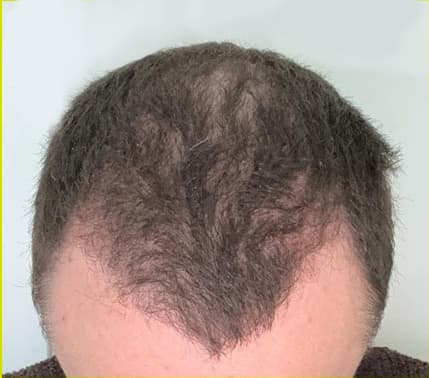 A close-up of the top of a man's head showing significant hair thinning and reduced hair density across the hairline and crown before treatment. The image represents male pattern hair loss that can be addressed with professional hair restoration and scalp rejuvenation treatments.
