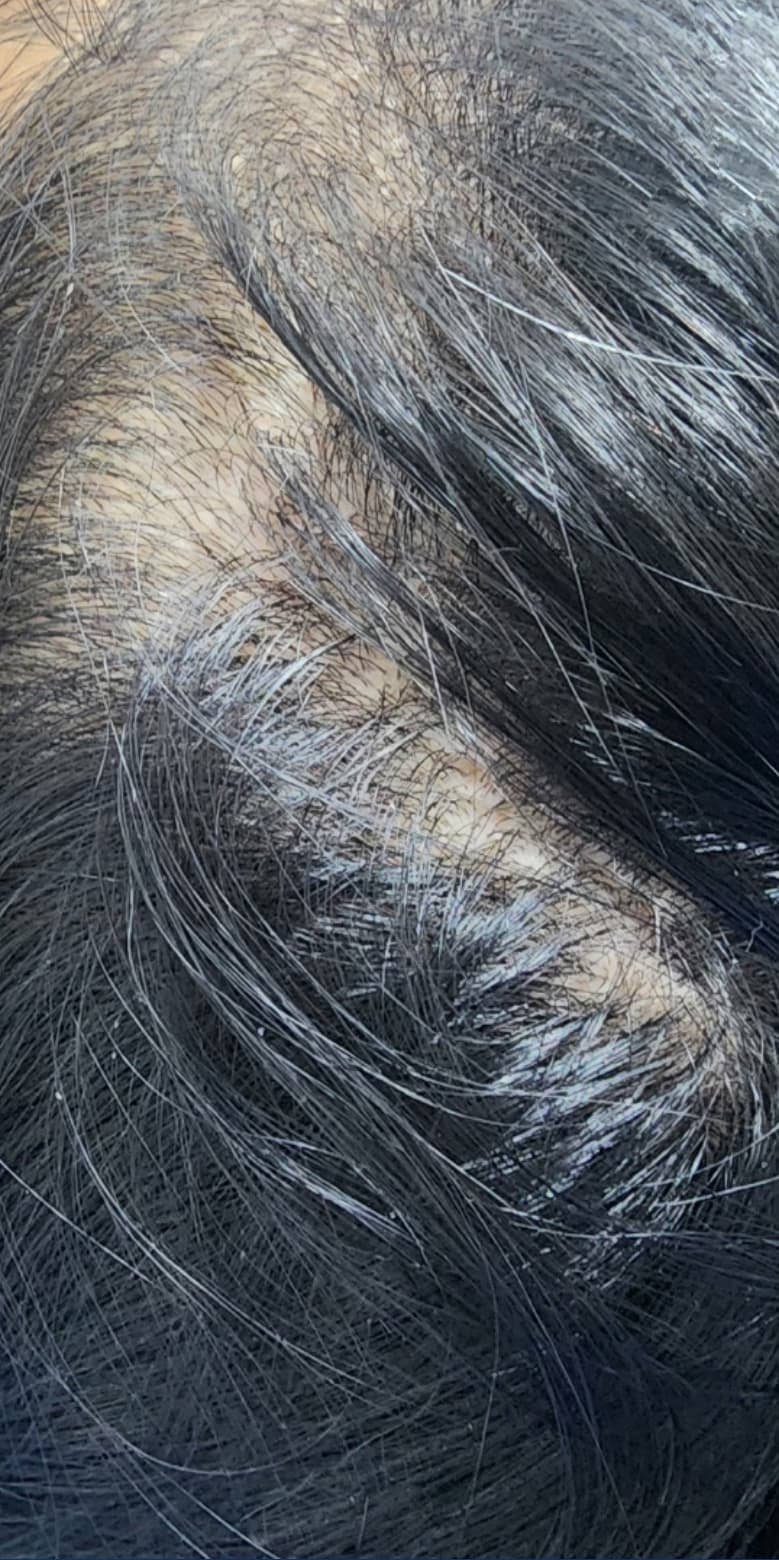 A close-up view of the scalp showing diffuse hair thinning with increased scalp visibility between sections of dark hair. The image represents early to moderate hair loss before treatment and illustrates a common concern addressed with professional non-surgical hair restoration and scalp rejuvenation therapies.