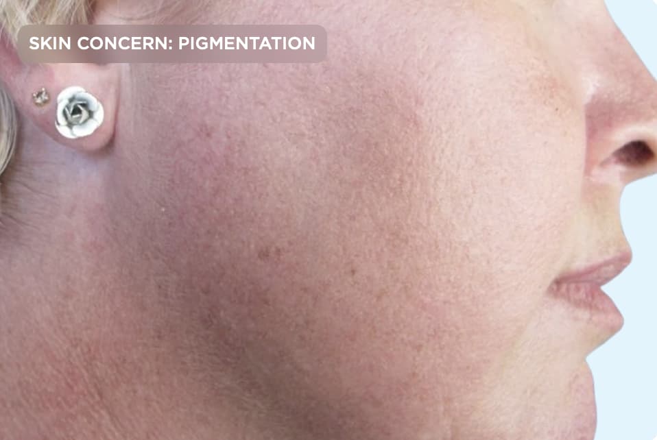 A close-up side profile of a person's cheek after pigmentation treatment, showing a more even skin tone with visibly reduced sun spots and discoloration. The image represents the results of professional skin rejuvenation treatments for hyperpigmentation and age spots.