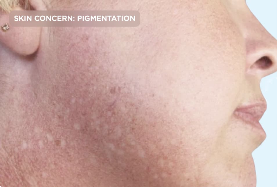A close-up side profile of a person's cheek showing visible pigmentation, sun damage, and uneven skin tone before treatment. The image represents concerns such as hyperpigmentation, age spots, and discoloration that can be addressed with professional skin rejuvenation treatments.