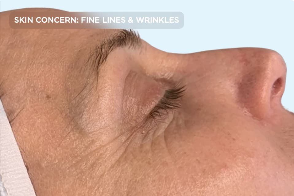 A close-up side profile of the eye area after treatment, showing smoother skin with visibly softened crow's feet and fine lines. The image represents the results of professional anti-aging skin rejuvenation treatments designed to reduce wrinkles and improve skin texture.