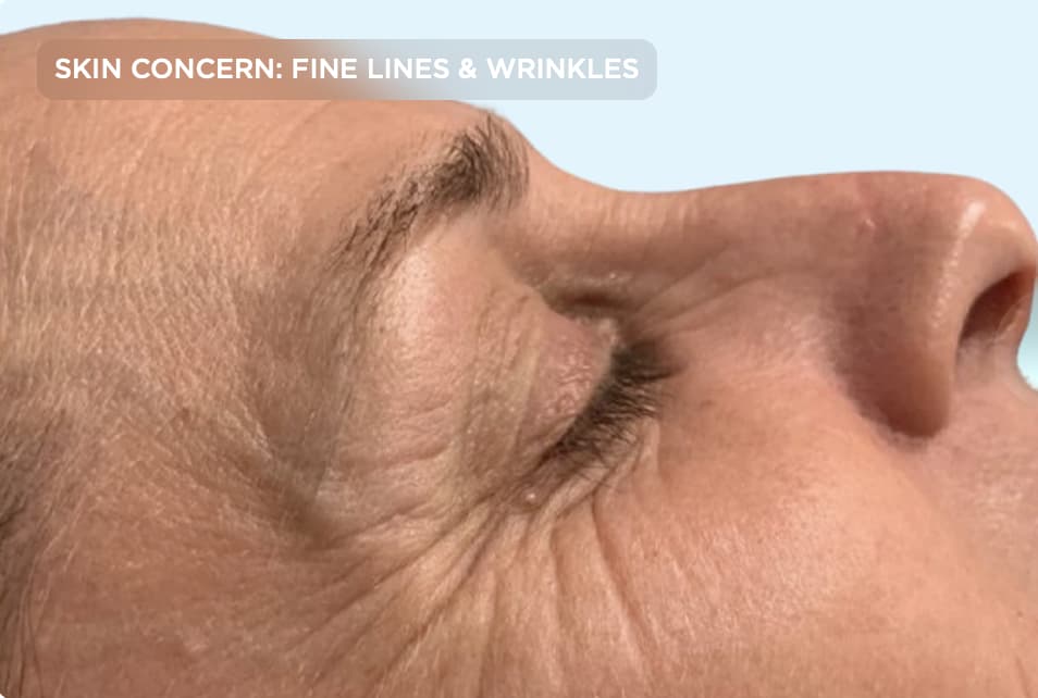 A close-up side profile of the eye area showing visible crow's feet, fine lines, and wrinkles before treatment. The image represents common signs of skin aging that can be improved with professional anti-aging and skin rejuvenation treatments.