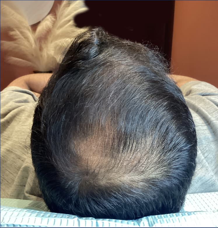 A top-down view of a person's scalp after professional hair restoration treatment, showing increased hair density and improved coverage across the crown. The image represents the results of non-surgical hair restoration treatments designed to reduce thinning and promote fuller, healthier hair growth.