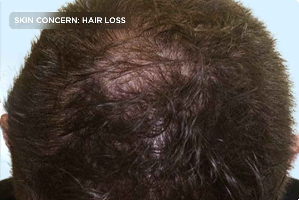 A close-up of the top of a person's scalp showing significant hair thinning at the crown with visible scalp. The image represents hair loss, thinning hair, male pattern baldness, and professional hair restoration or scalp treatment options.