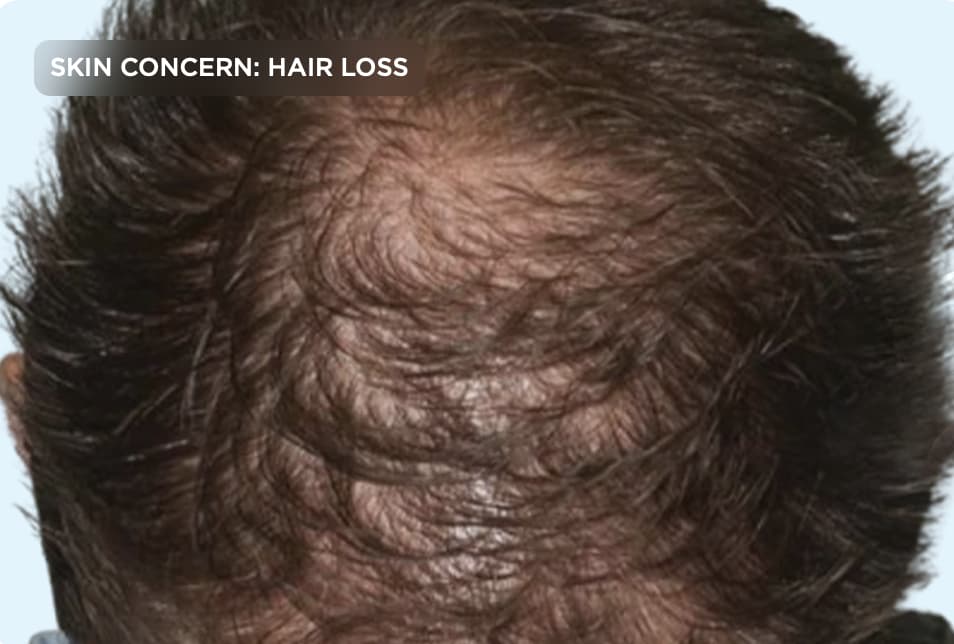 A close-up of the top of a person's scalp showing noticeable hair thinning and reduced hair density. The image represents hair loss concerns, thinning hair, androgenetic alopecia, and professional hair restoration or scalp treatment options.