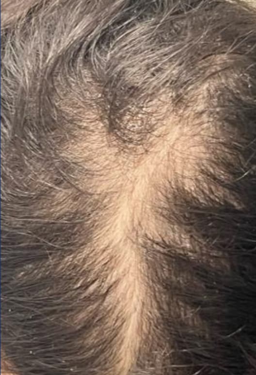 A close-up view of the top of a person's scalp showing widening of the natural part line caused by hair thinning. The image represents early to moderate hair loss before treatment and illustrates a common concern addressed with non-surgical hair restoration and scalp rejuvenation therapies.