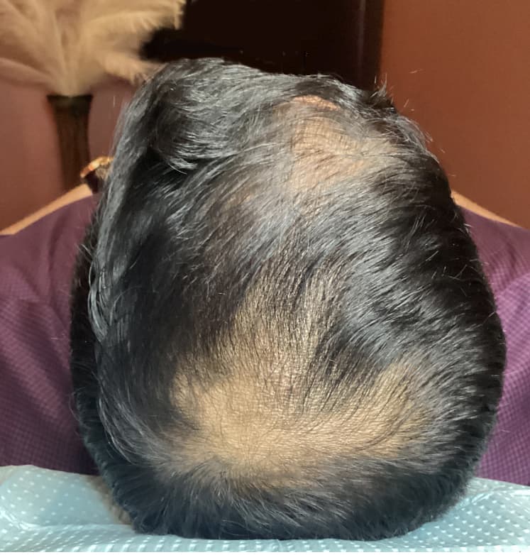 A top-down view of a person's scalp showing significant hair thinning across the crown and top of the head before treatment. The image represents advanced hair loss that can be addressed with professional non-surgical hair restoration and scalp rejuvenation treatments.