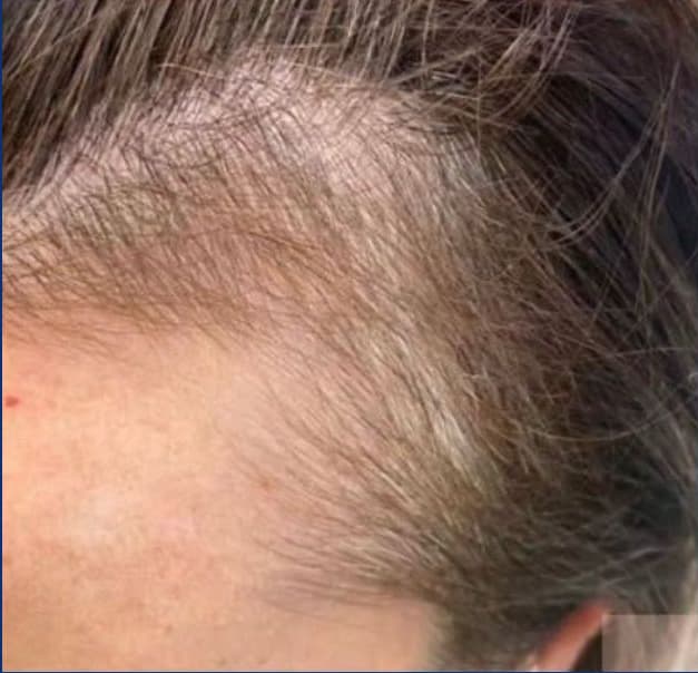 A close-up of the hairline showing visible hair thinning and reduced hair density along the temple before treatment. The image represents early-stage hair loss that can be addressed with professional hair restoration and scalp rejuvenation treatments.