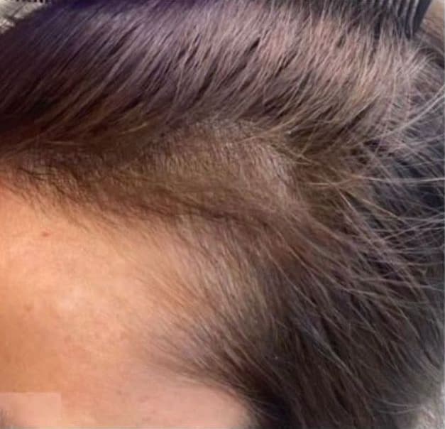 A close-up of the hairline after professional hair restoration treatment, showing improved hair density and fuller hair growth along the temple. The image represents the results of non-surgical hair restoration treatments designed to reduce thinning and promote healthier hair growth.
