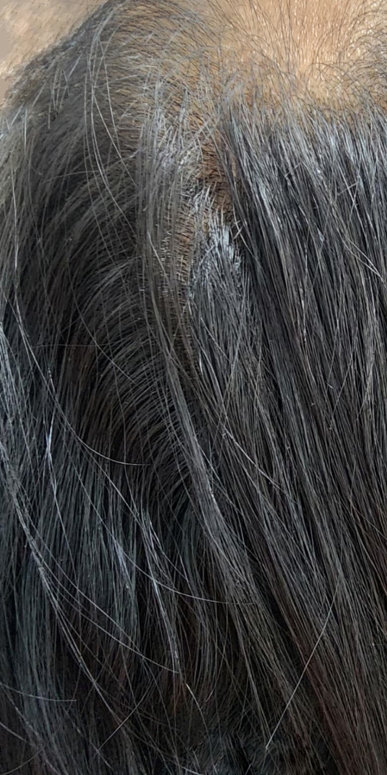 A close-up view of the scalp after non-surgical hair restoration treatment, showing fuller hair growth and reduced scalp visibility compared to before treatment. The image demonstrates improved hair density and healthier-looking coverage, representing the results of professional hair restoration therapies.