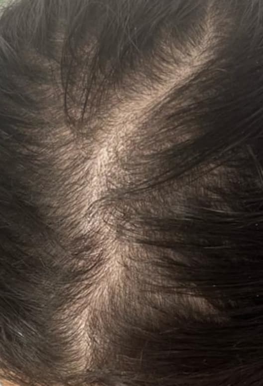 A close-up view of the top of a person's scalp after non-surgical hair restoration treatment, showing a narrower part line and increased hair density. The image demonstrates fuller hair growth and improved scalp coverage, representing the results of professional hair restoration therapies for thinning hair.