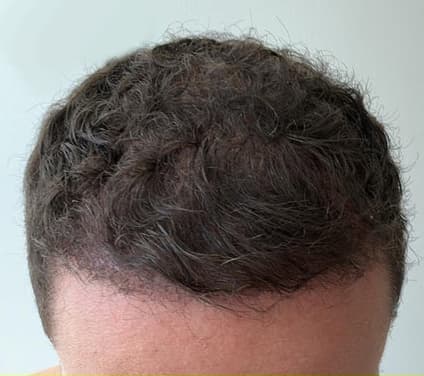 A close-up of the top of a man's head after professional hair restoration treatment, showing noticeably improved hair density and fuller coverage across the hairline and crown. The image represents the results of non-surgical hair restoration treatments for male pattern hair loss.