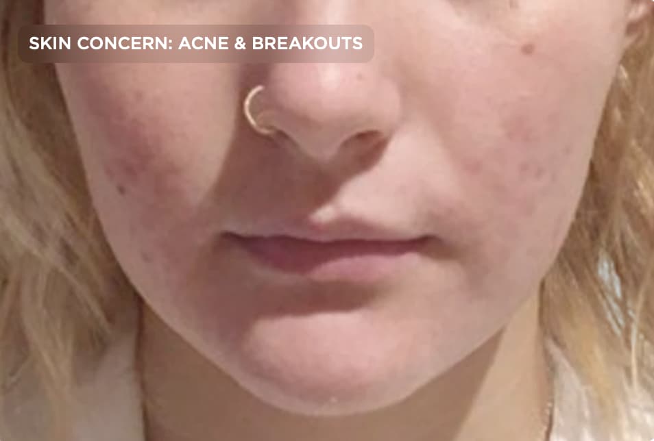 A close-up of a person's face showing clearer skin with significantly reduced acne and breakouts after professional treatment. The image represents acne treatment results, improved skin texture, reduced blemishes, and healthier-looking skin following medical-grade skincare or aesthetic treatments.