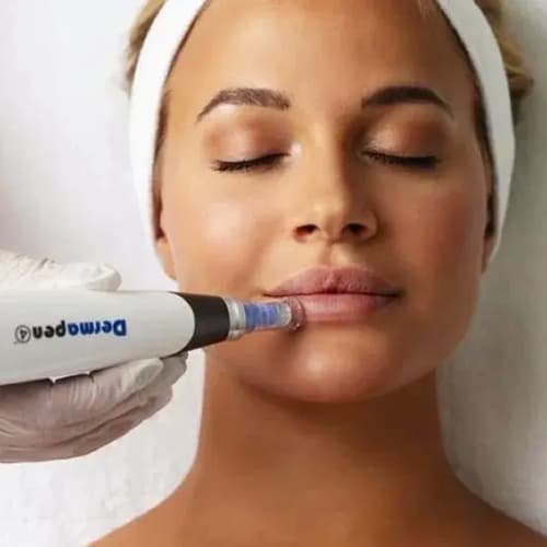 A close-up of a woman receiving a professional microneedling treatment around the lips using a Dermapen device. The image represents collagen induction therapy for skin rejuvenation, fine lines, improved skin texture, and overall facial rejuvenation.