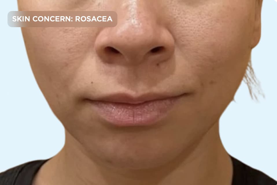 A close-up of a person's face after professional rosacea treatment, showing a more even skin tone with significantly reduced redness across the cheeks and nose. The image represents improved skin clarity, calmer sensitive skin, and successful rosacea management through aesthetic care.