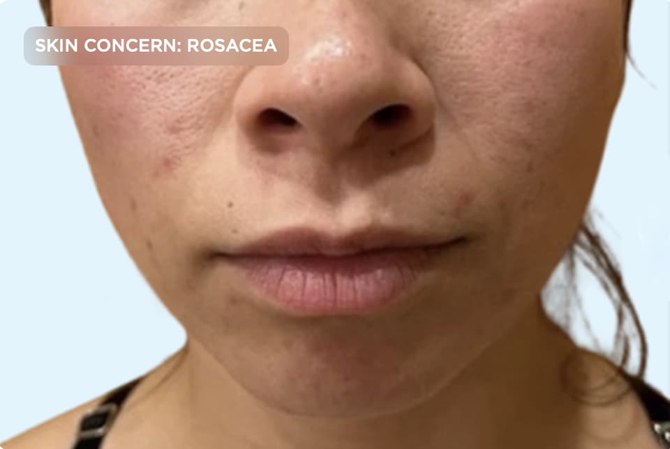 A close-up of a person's face showing facial redness and visible rosacea across the cheeks and nose. The image represents rosacea concerns, facial redness, sensitive skin, and professional aesthetic treatments designed to improve skin tone and reduce inflammation.
