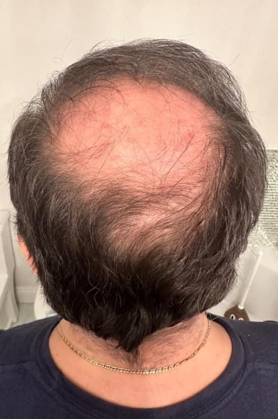 A rear view of a person's scalp showing advanced hair thinning across the crown and vertex, with significant scalp visibility due to hair loss. The image represents severe androgenetic alopecia before treatment and illustrates a common concern addressed with professional non-surgical hair restoration and scalp rejuvenation therapies.
