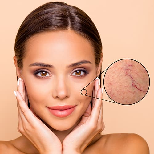 A close-up portrait of a woman with an inset highlighting visible facial spider veins on the cheek. The image represents vascular skin concerns such as spider veins and broken capillaries that can be treated with professional laser or aesthetic skin treatments.