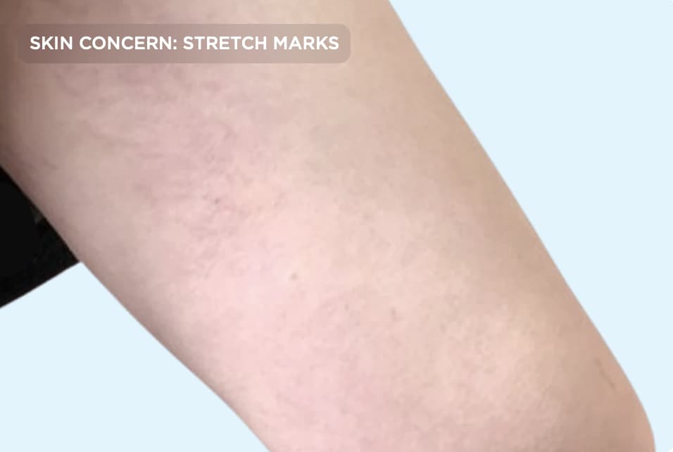 A close-up of the upper thigh after stretch mark treatment, showing smoother skin with significantly reduced stretch marks and a more even skin texture. The image represents the results of professional skin rejuvenation treatments designed to improve the appearance of stretch marks.