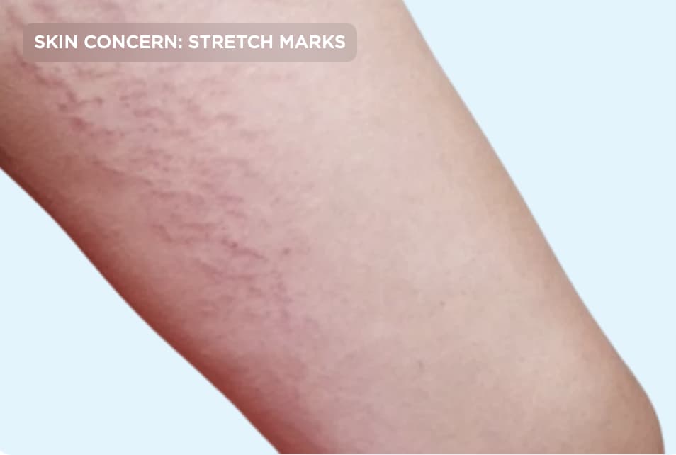 A close-up of the upper thigh showing visible stretch marks before treatment. The image represents skin texture changes caused by growth, pregnancy, or weight fluctuations that can be improved with professional stretch mark and skin rejuvenation treatments.