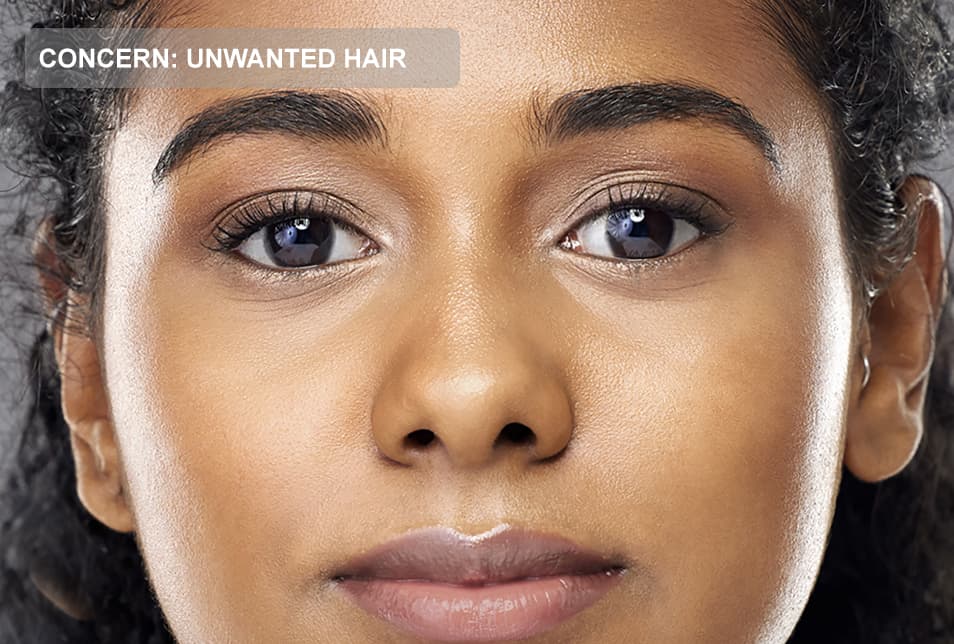 A close-up of a woman's face showing unwanted hair between the eyebrows and along the brow line. The image represents unwanted facial hair concerns, laser hair removal, facial hair reduction, and professional aesthetic treatments for long-lasting smooth skin.