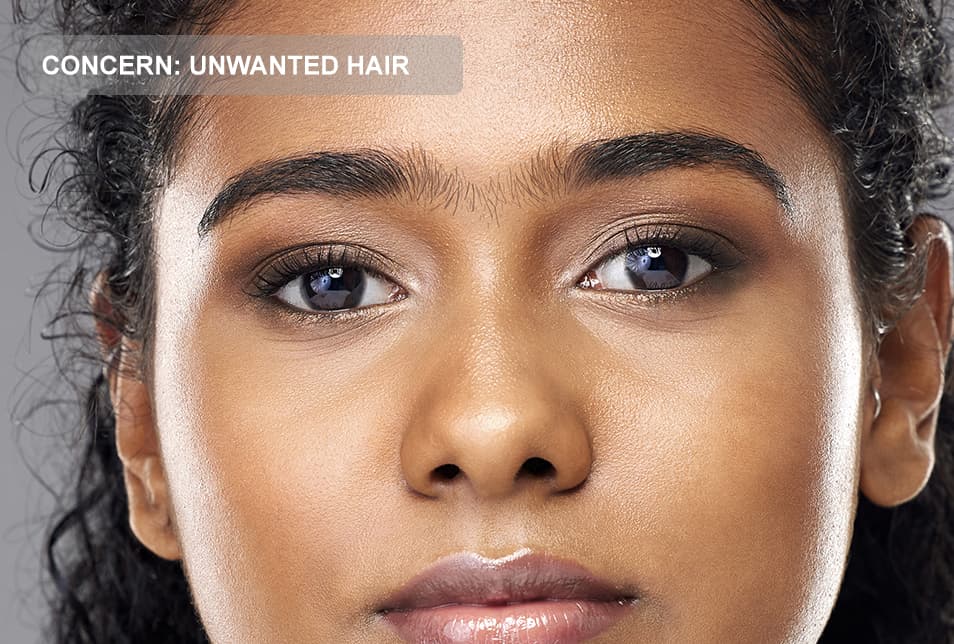 A close-up of a woman's face highlighting unwanted hair between the eyebrows. The image represents unwanted facial hair concerns, laser hair removal, facial hair reduction, and professional aesthetic treatments for smooth, hair-free skin.